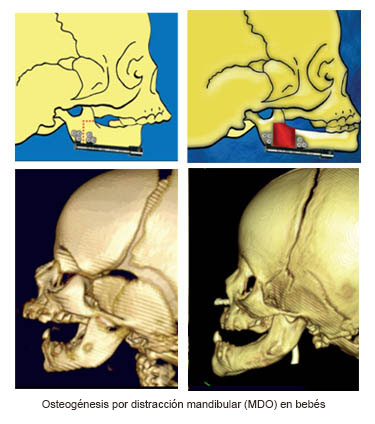 https://babybunko.store/SiteCollectionImages/Infant_Mandibular_Distraction_Osteogenesis_es.jpg