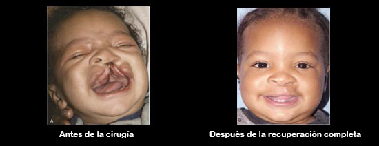 https://babybunko.store/SiteCollectionImagesArticleImages/CleftbeforeAfter_Baby_es.jpg