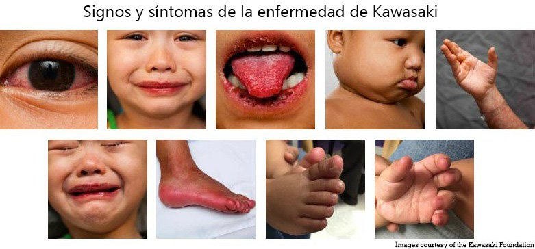https://babybunko.store/SiteCollectionImagesArticleImages/Signs_Symptoms_Kawasaki_Disease_es.jpg
