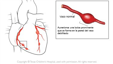 https://babybunko.store/SiteCollectionImagesArticleImages/aneurysm_texaschildrens_es.jpg