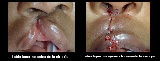 https://babybunko.store/SiteCollectionImagesArticleImages/cleftLipBeforeAfter2_es.jpg